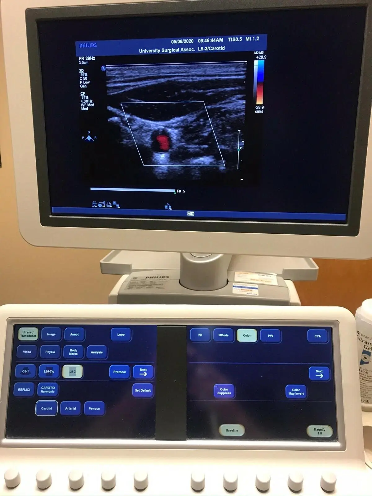 Used Philips Philips iE33 "R" Revision Ultrasound on Cart — Refurbished Medical Imaging - Other Texas US | PT Medical Technologies #1458985