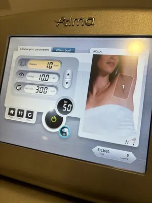Used 2020 ALMA SOPRANO ICE HAIR REMOVAL LASER Lasers / Laser Systems Minnesota US | Midwest Medical #1467821